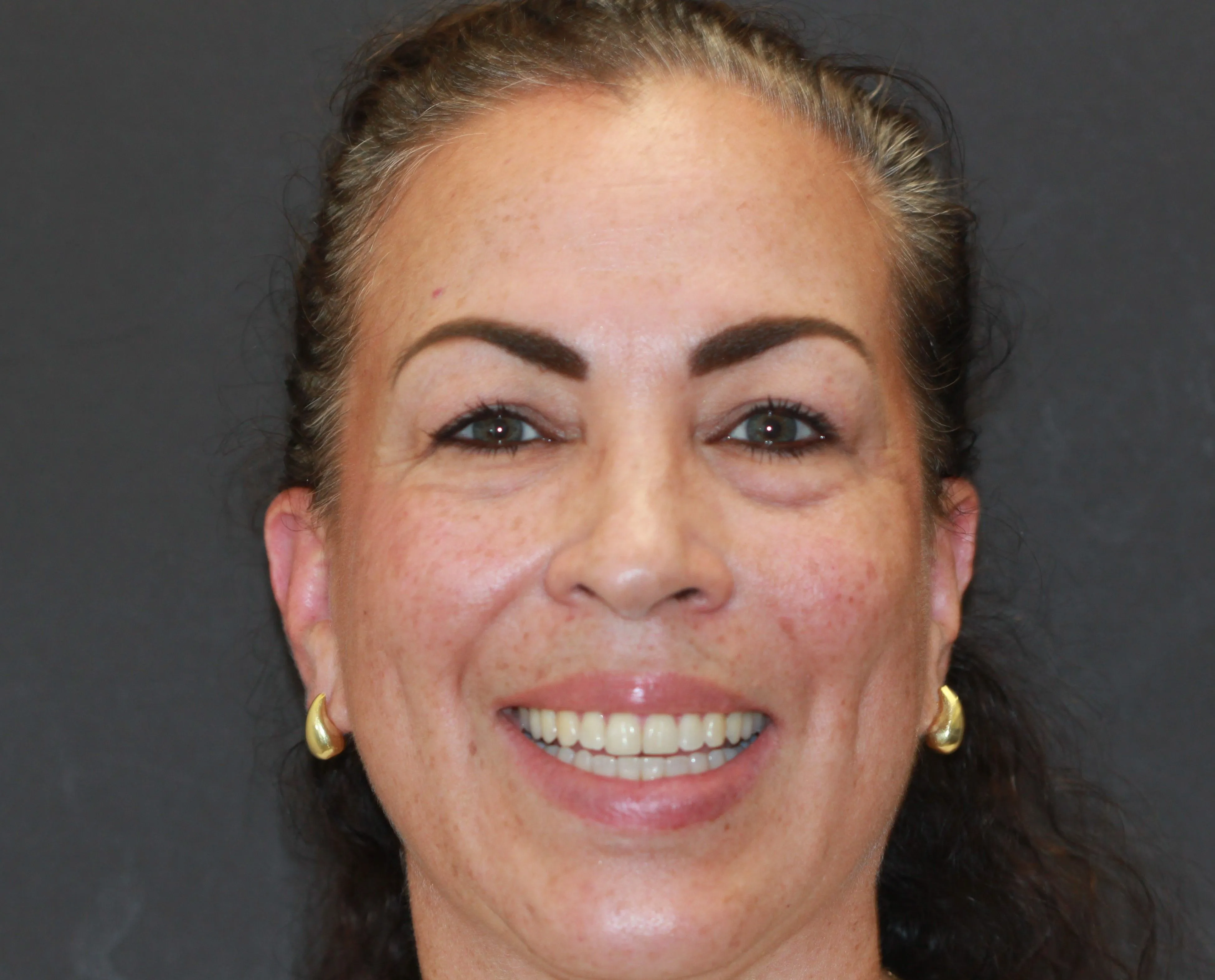 Smile Makeover - After