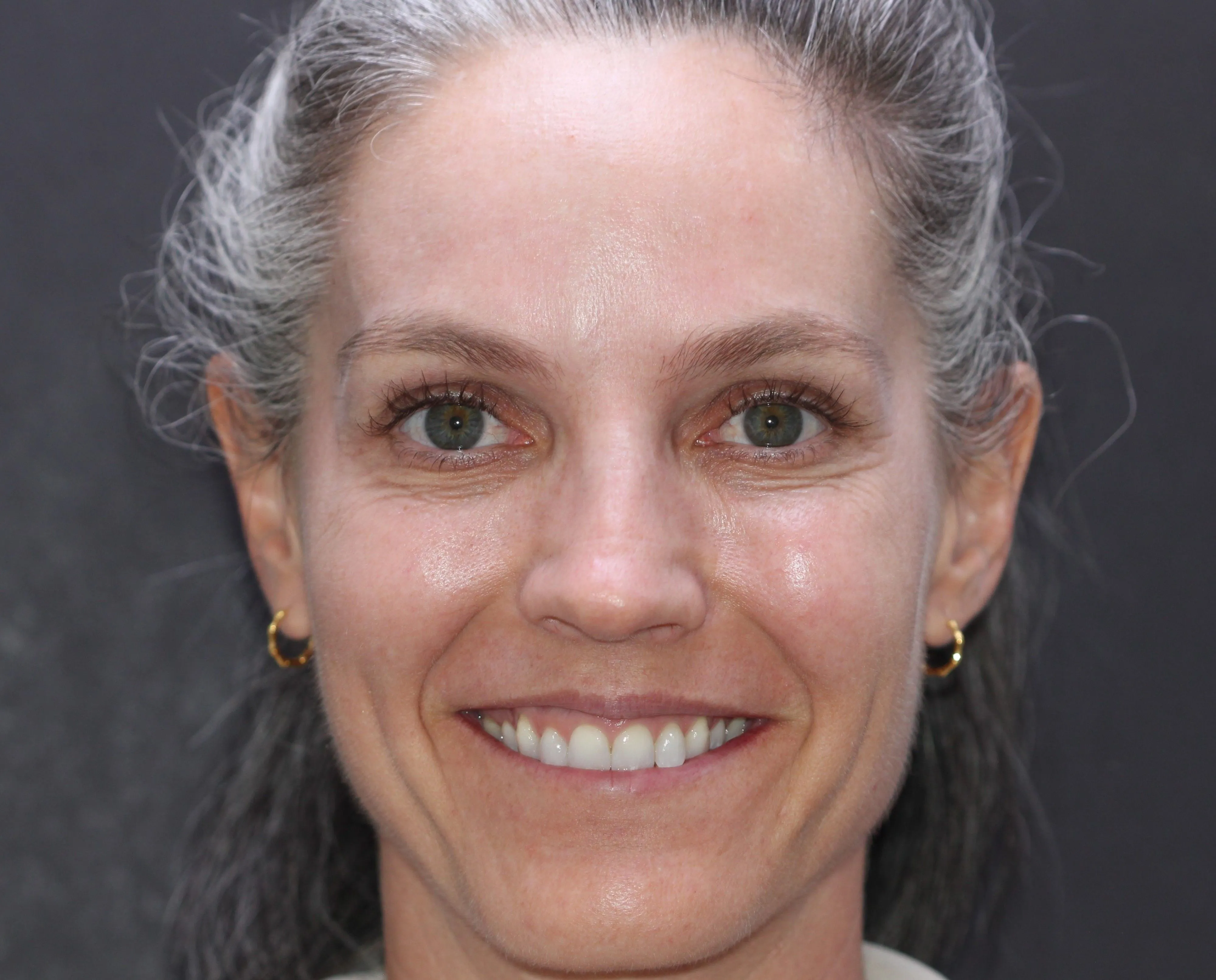 Invisalign - Before