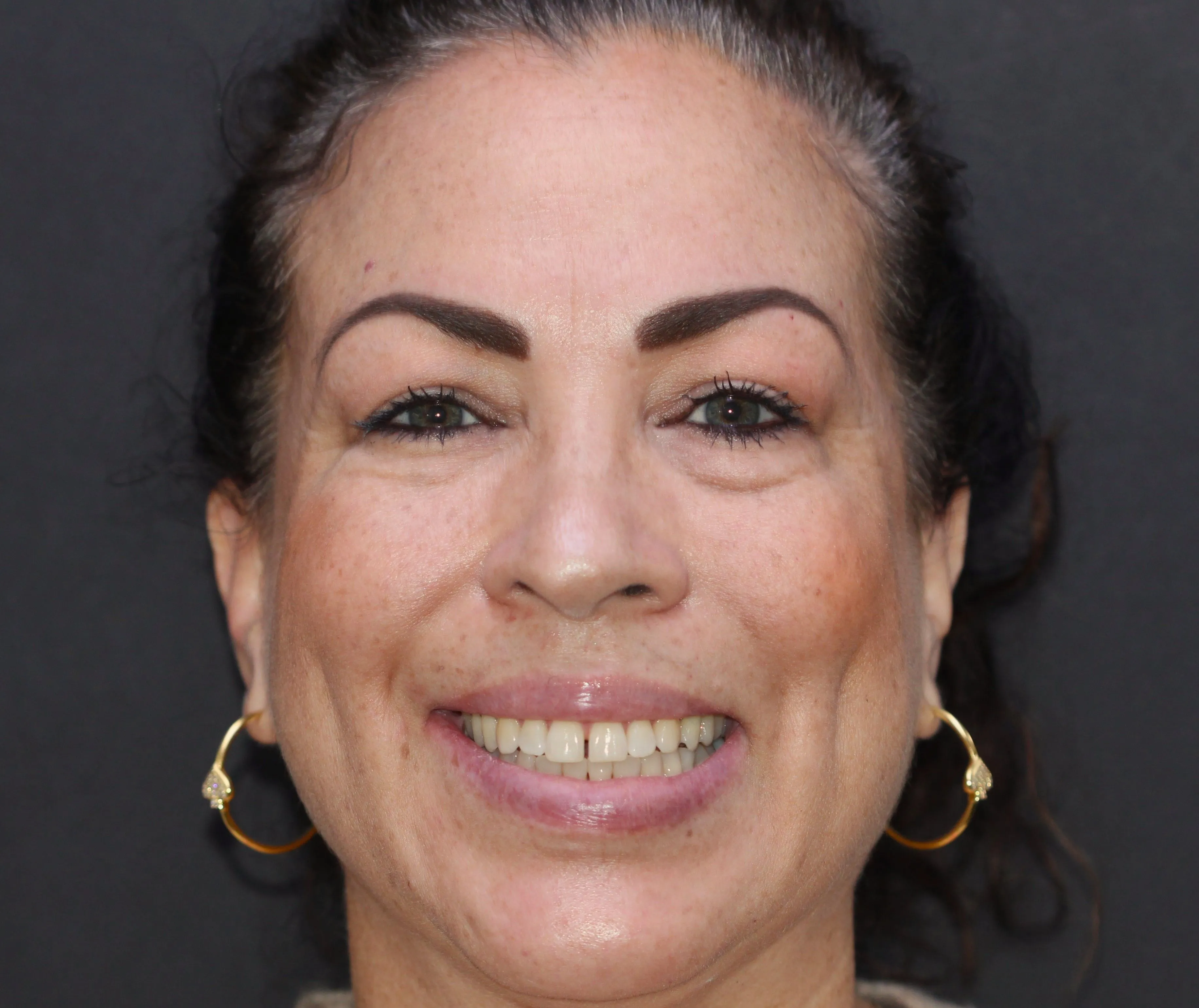 Smile Makeover - Before