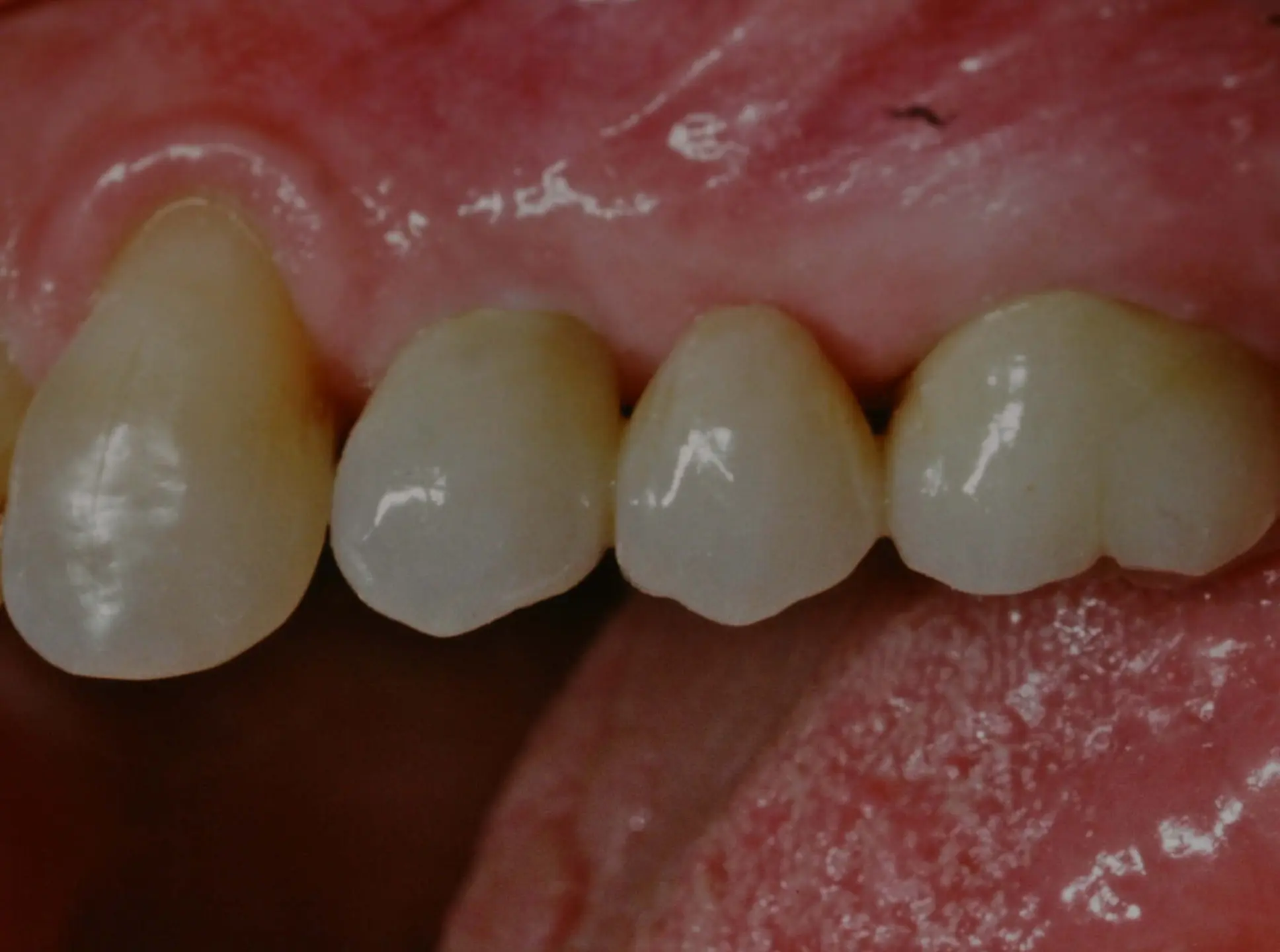Dental bridge restoration