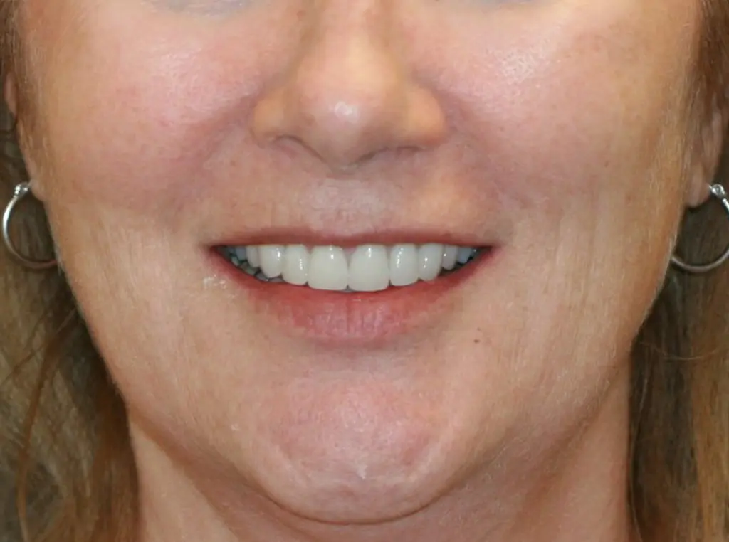 Dental crown restoration