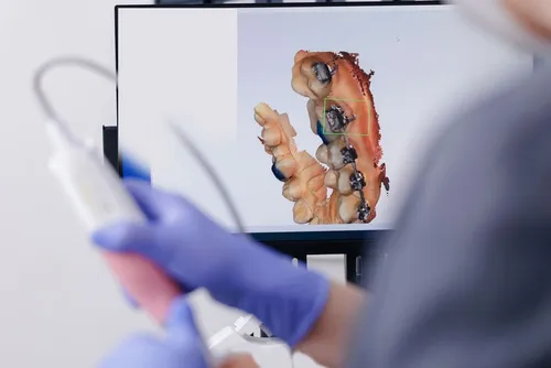 Digital intraoral scanner creating a 3D model of teeth