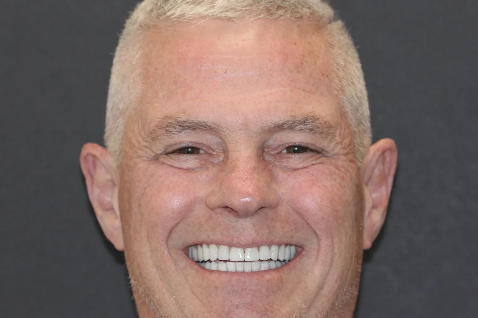 Full-Mouth Reconstruction - After