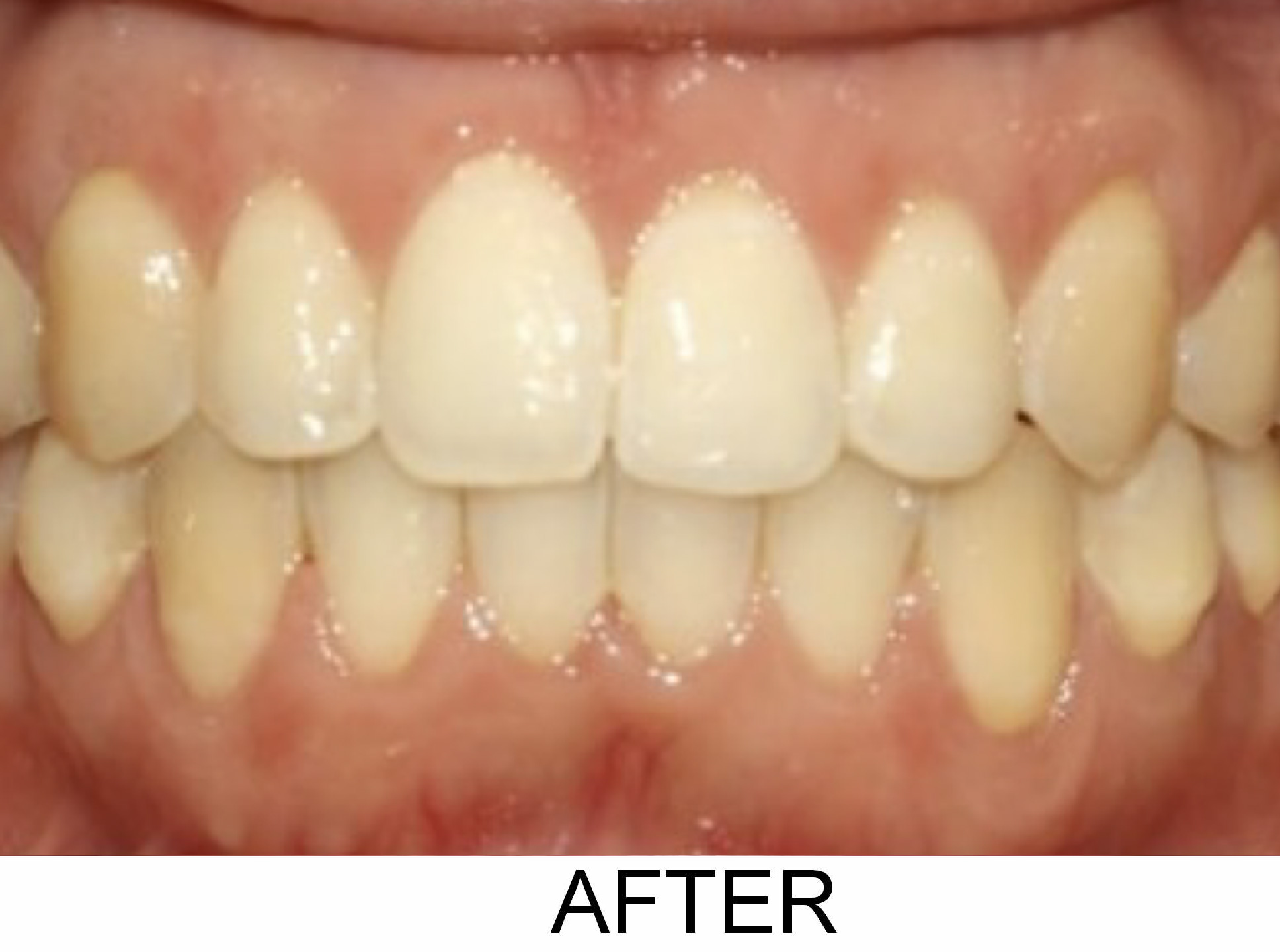 Anterior Open Bite - After