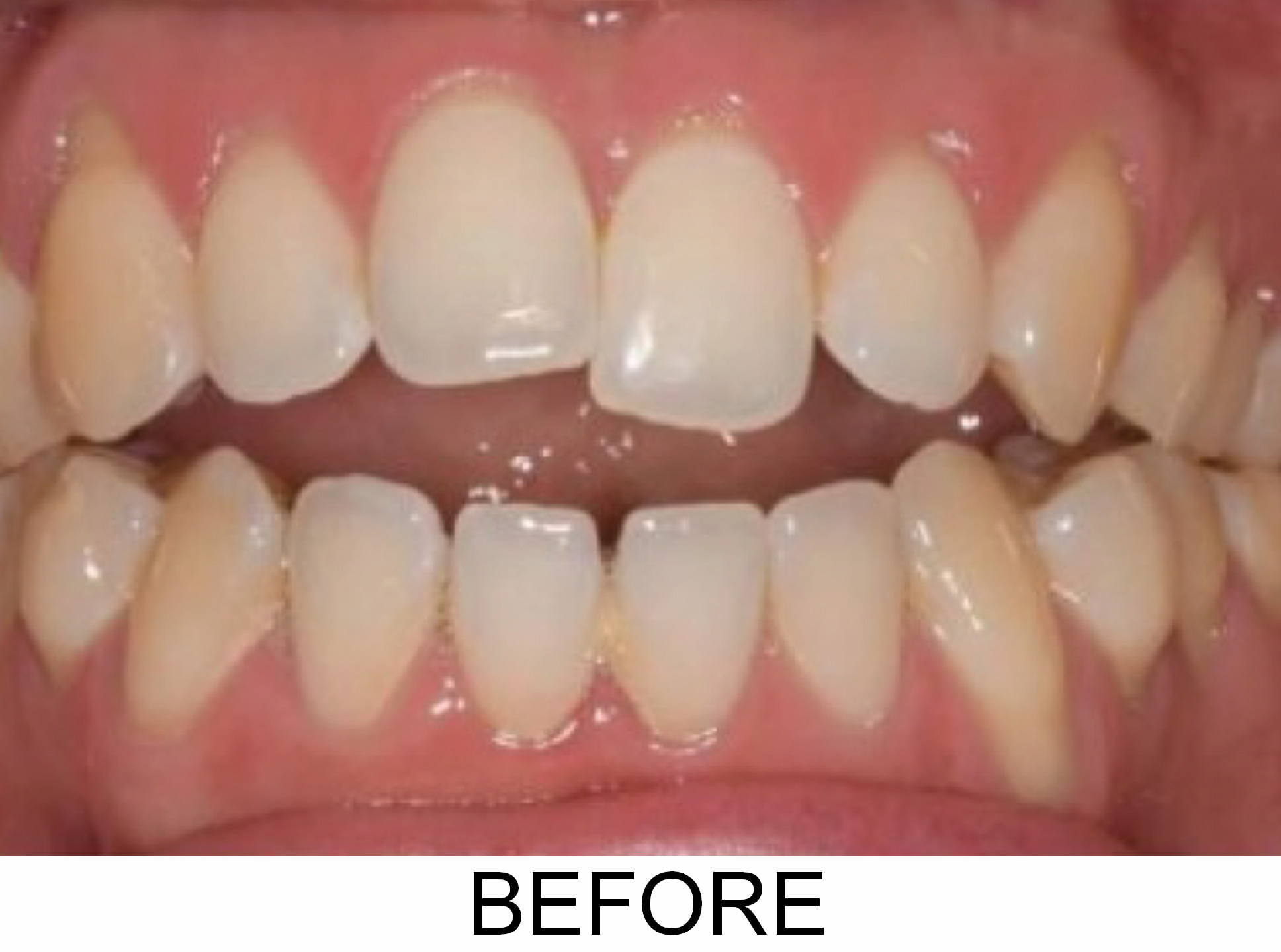 Anterior Open Bite - Before