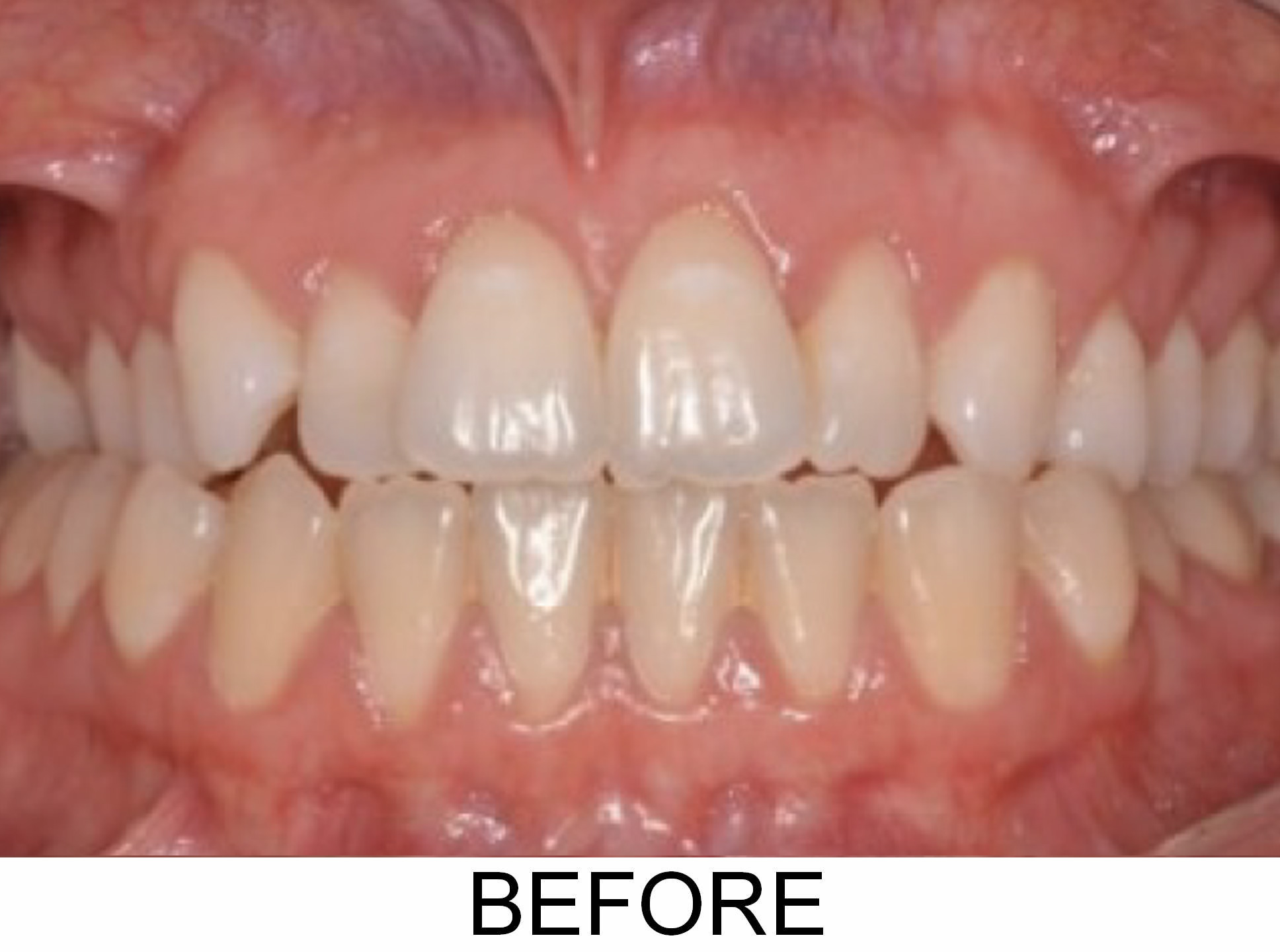 Edge-to-Edge Crossbite - Before