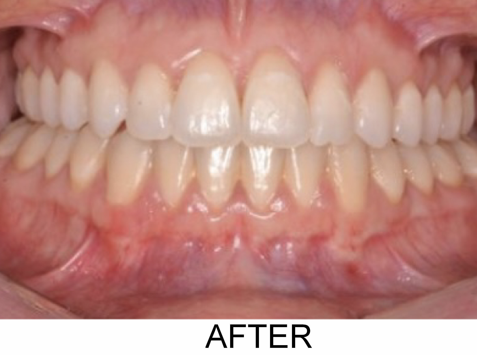 Edge-to-Edge Crossbite - After