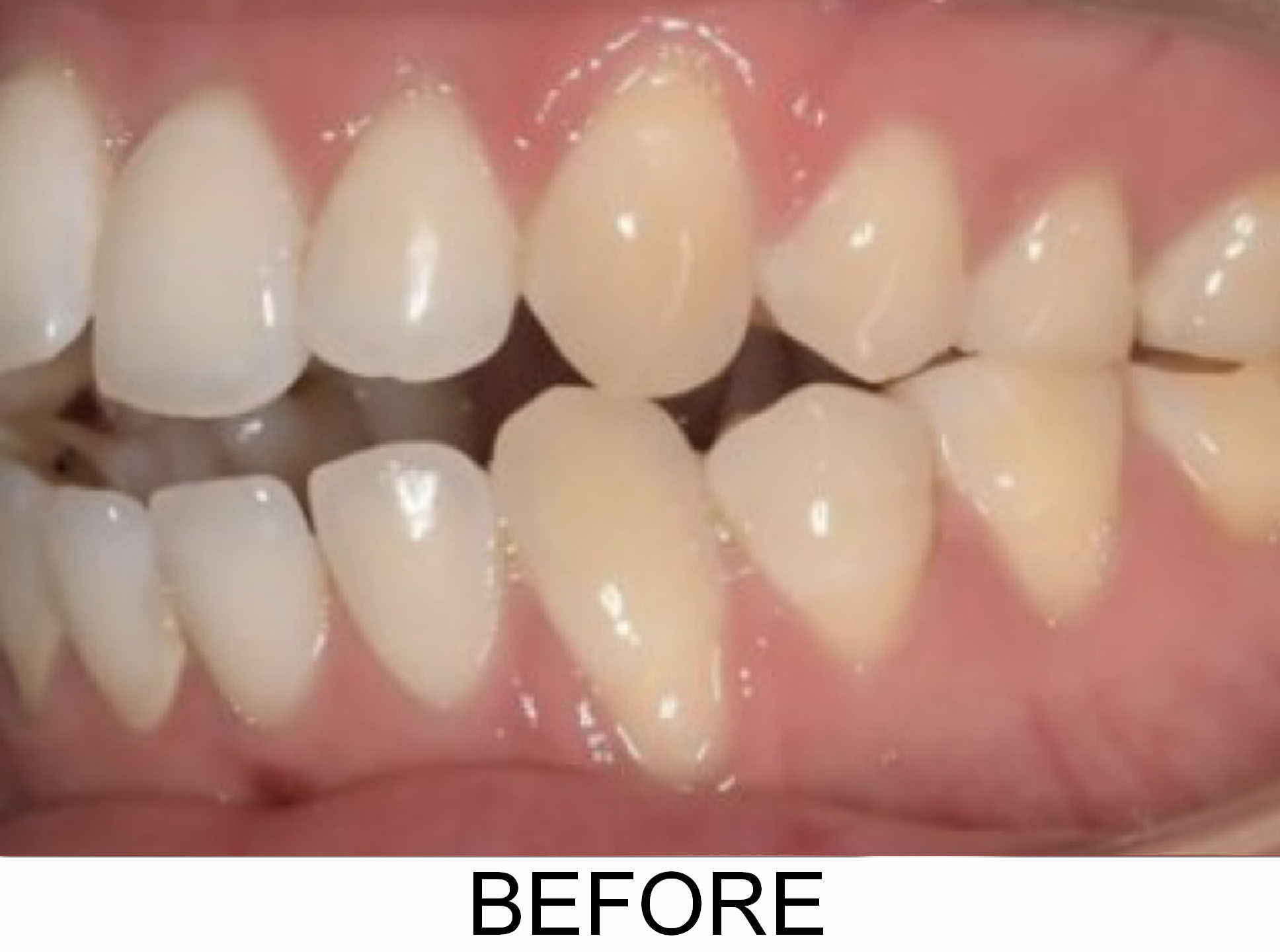 Gum Recession - Before