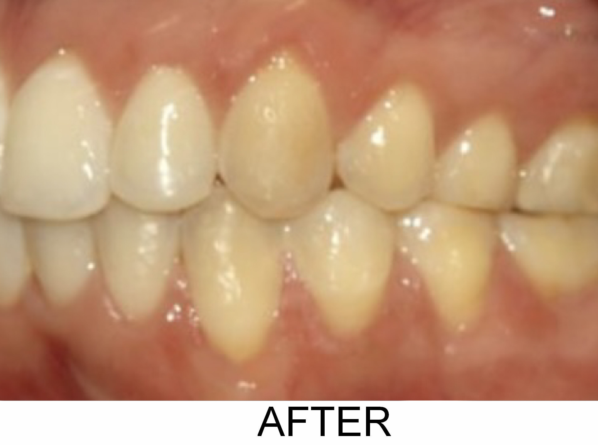 Gum Recession - After