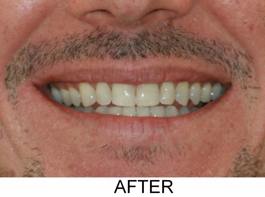Invisalign - After