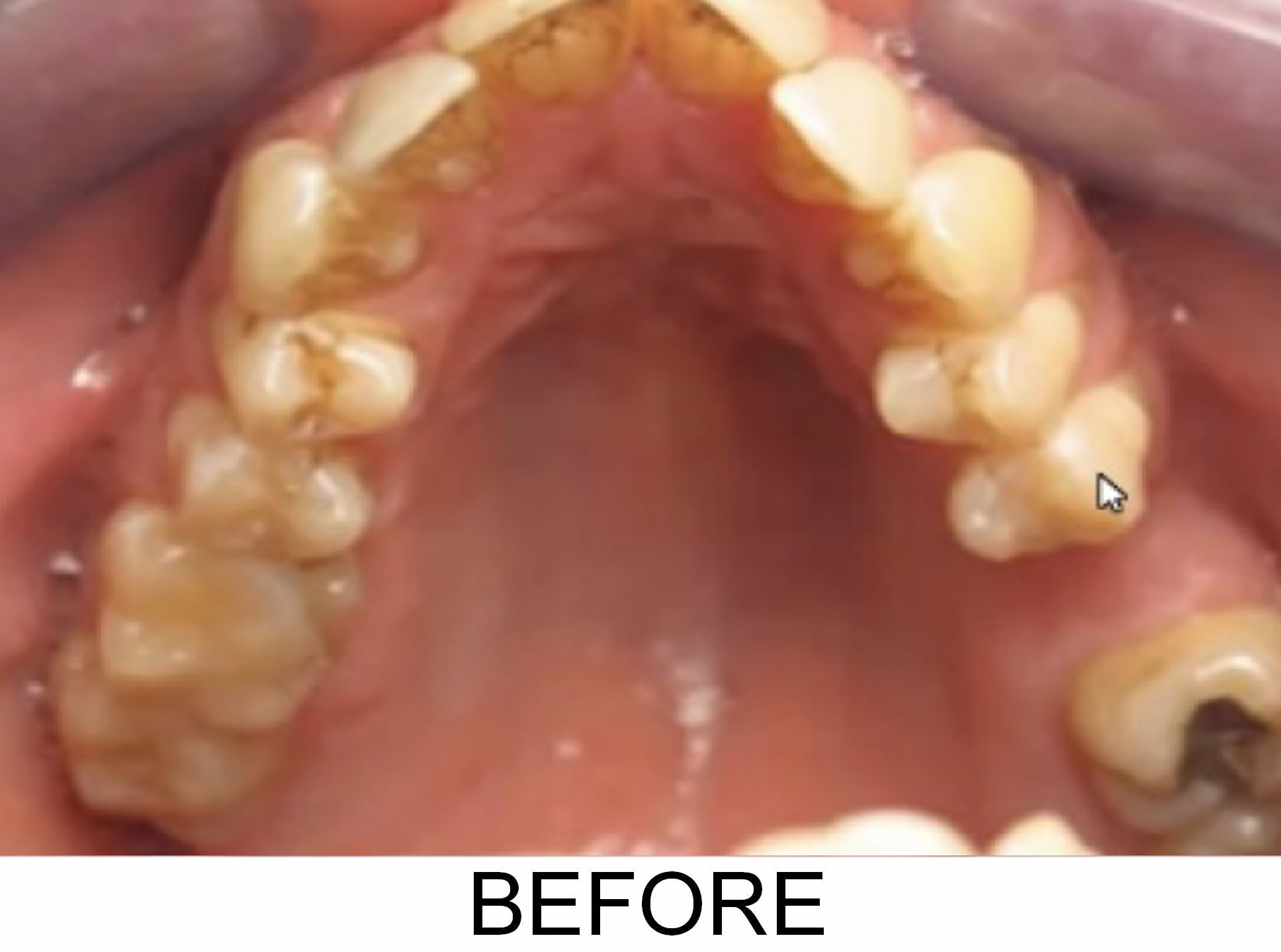 Narrow Arches - Before