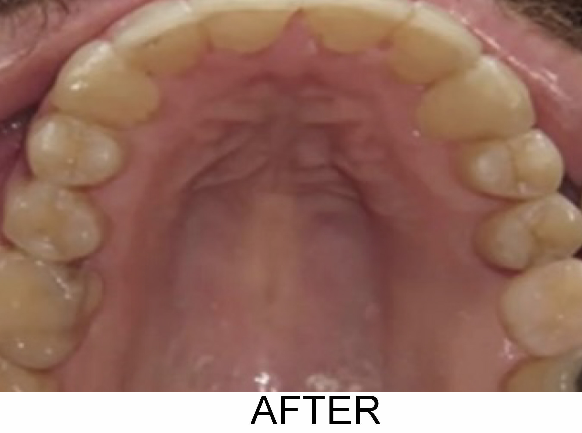 Narrow Arches - After