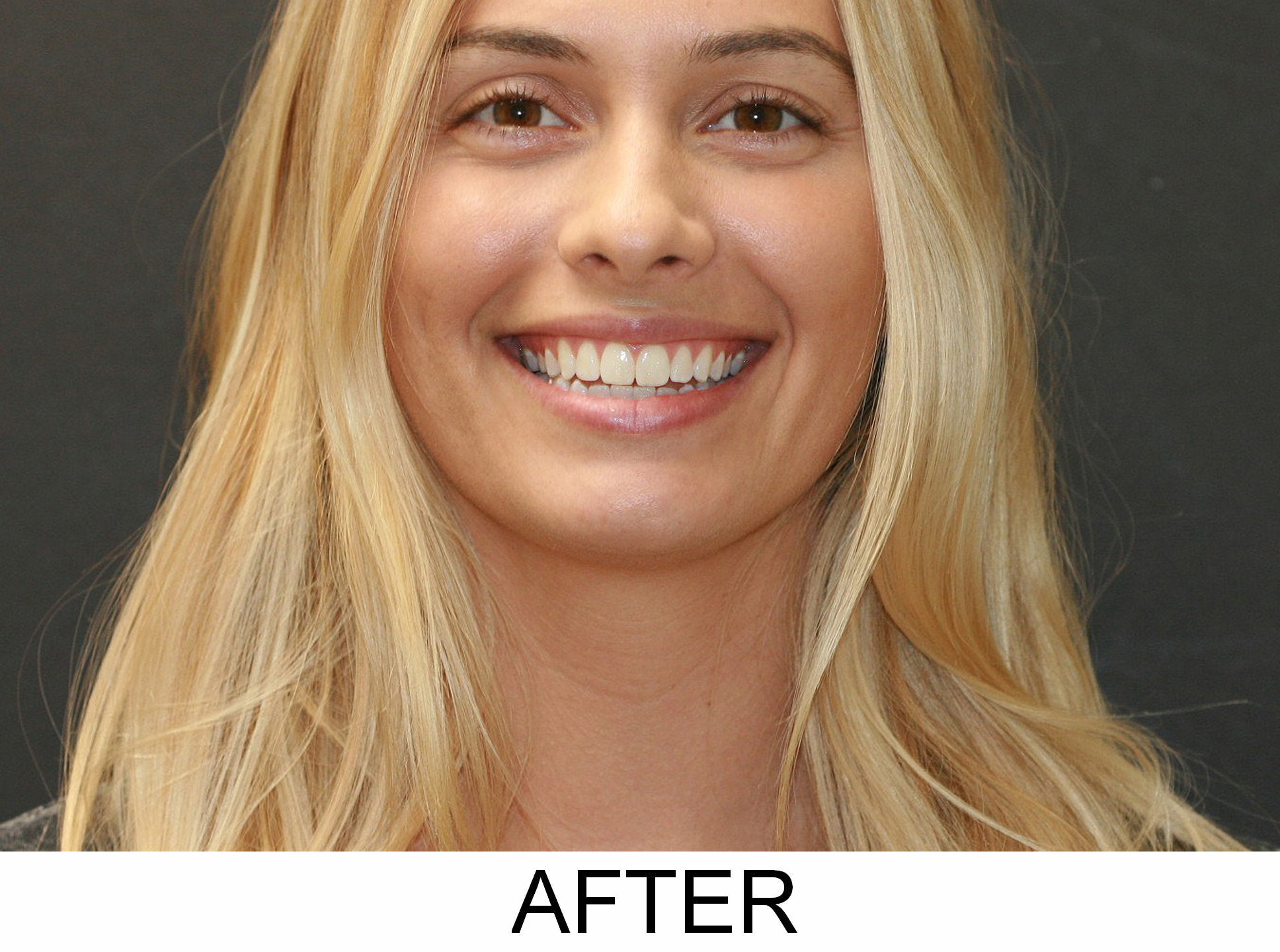 Invisalign - After