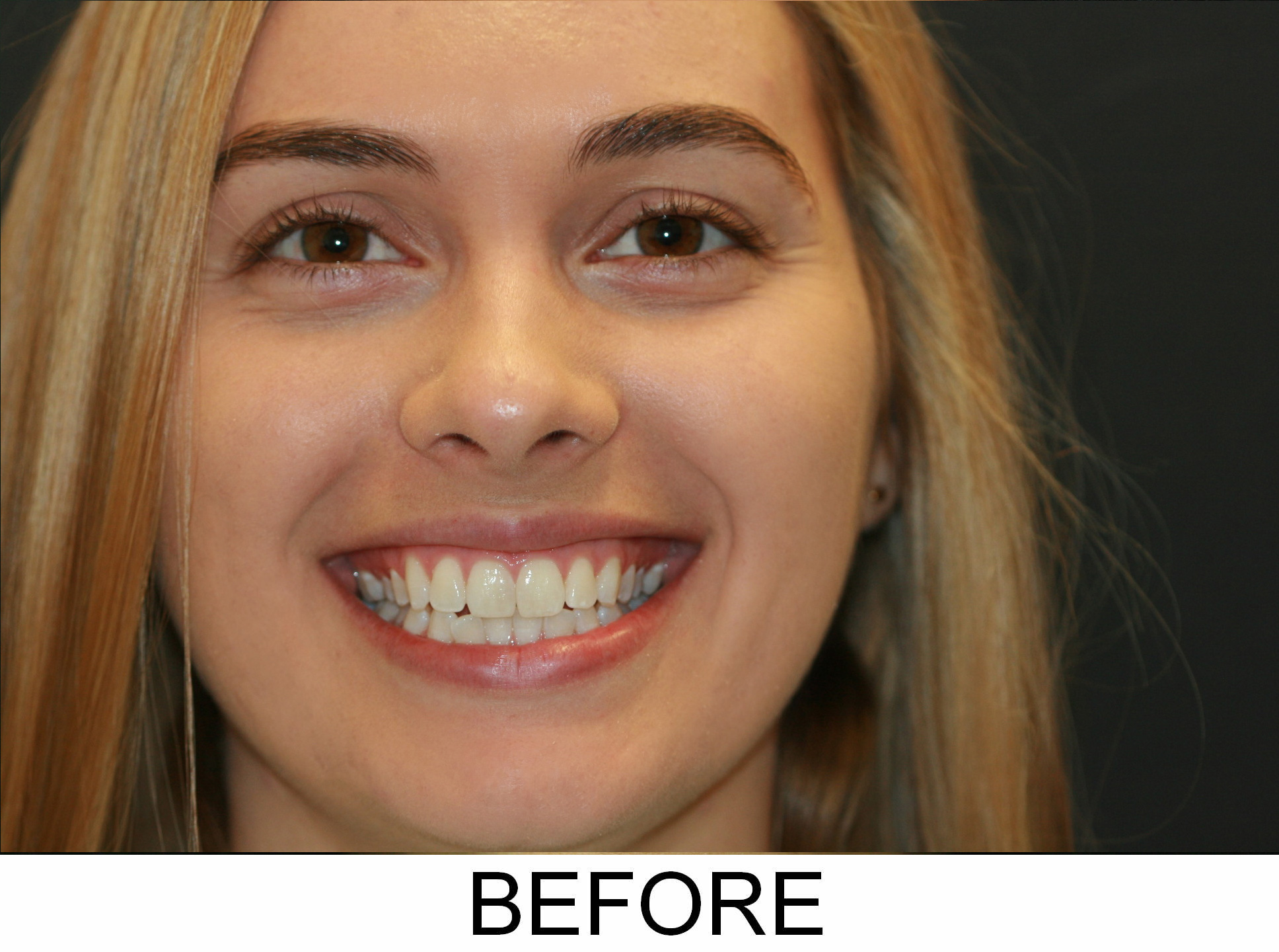 Invisalign - Before