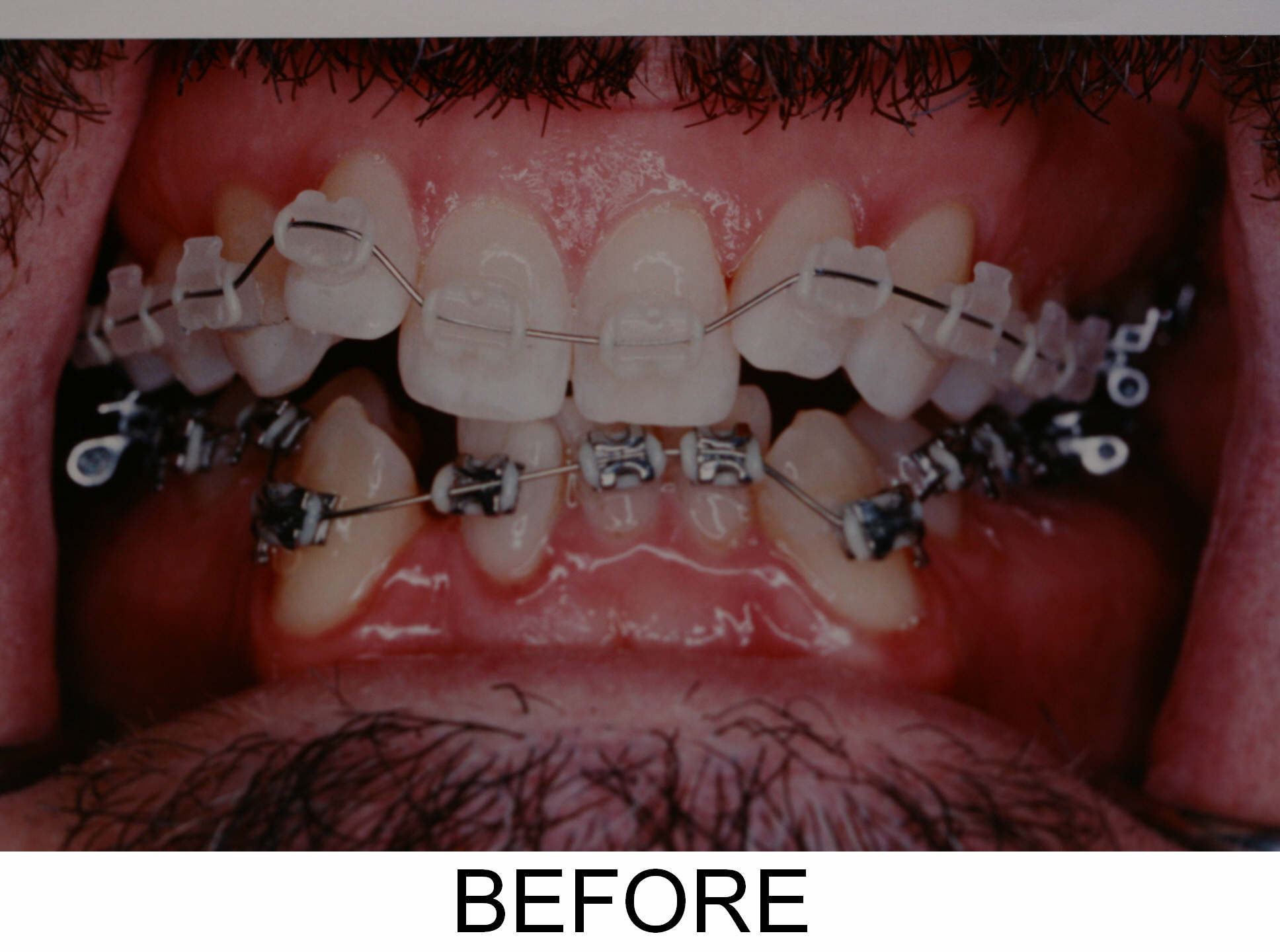 Braces - Before