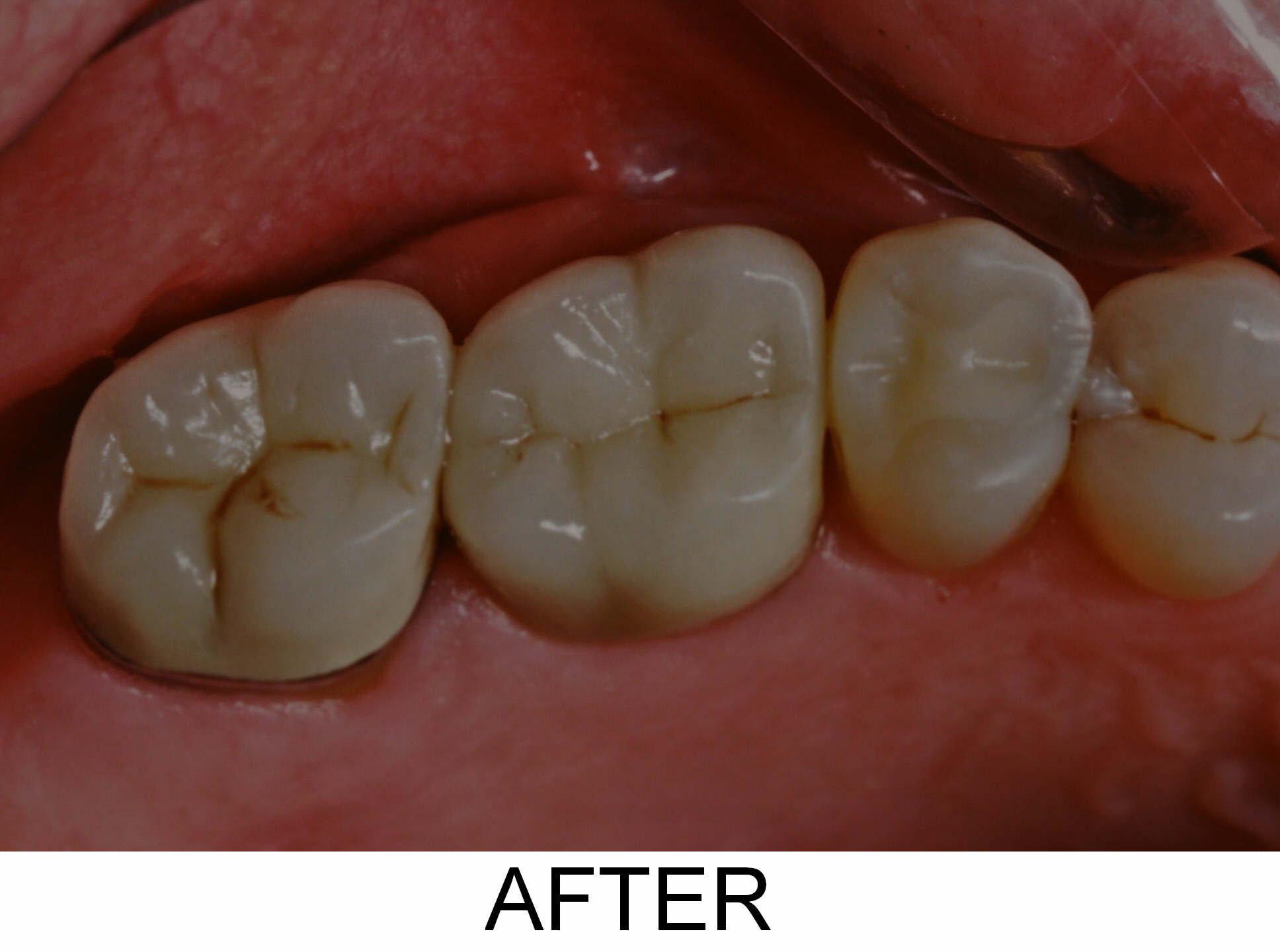 Crowns and Fillings - After