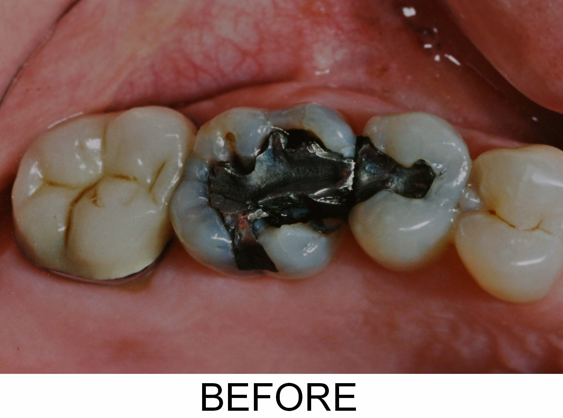 Crowns and Fillings - Before
