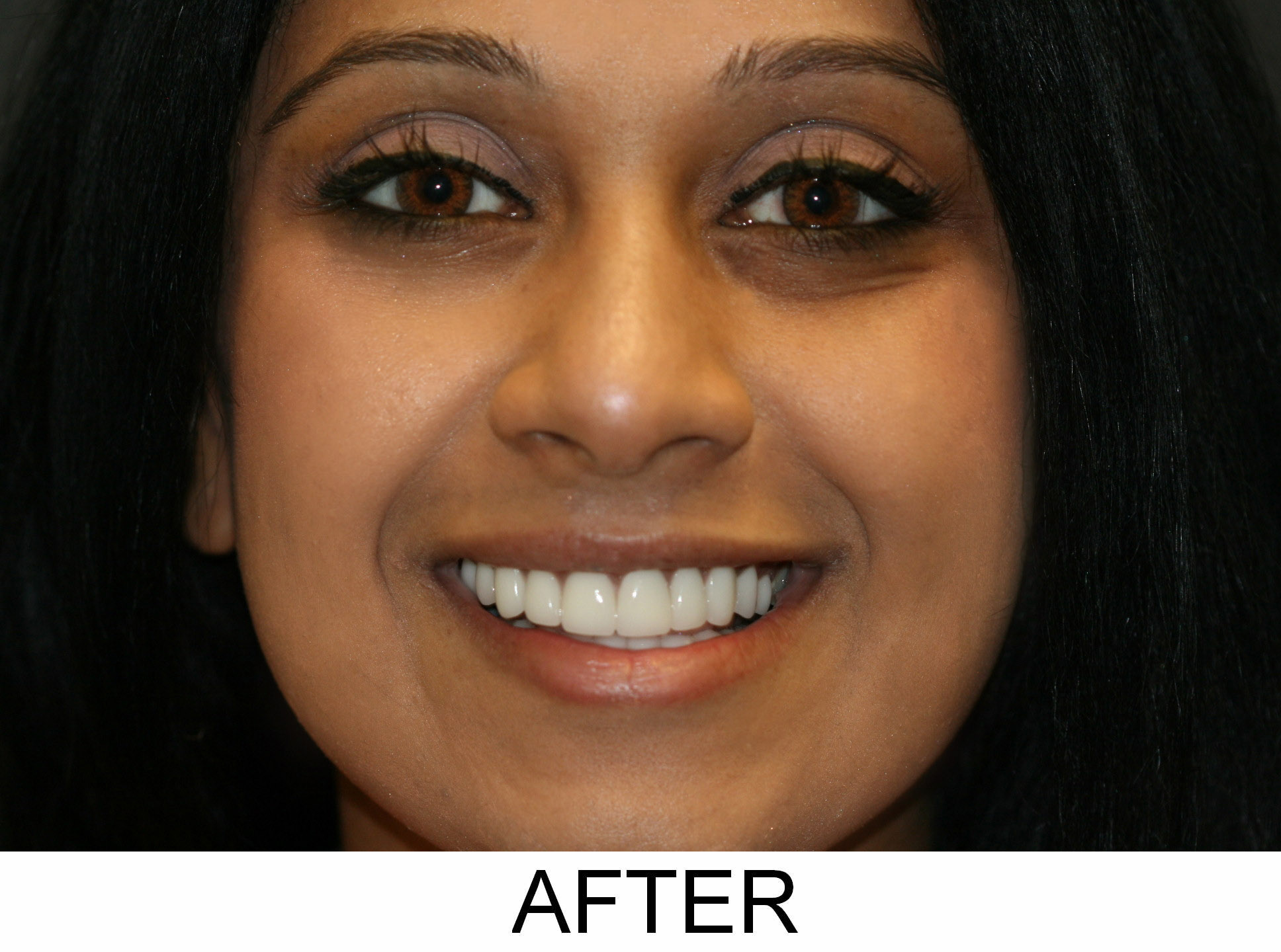 Crowns and Veneers - After