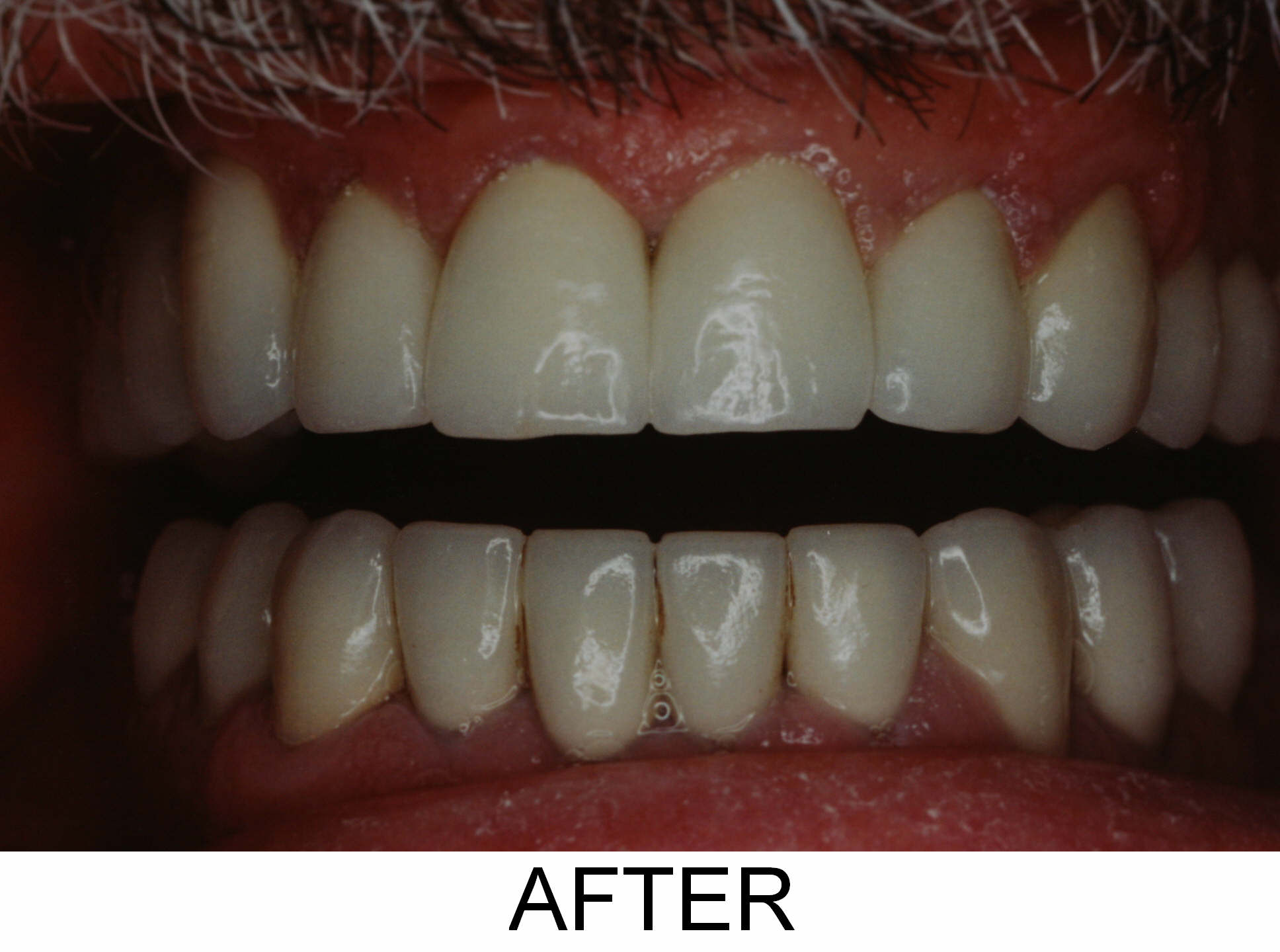 Crowns and Veneers - After