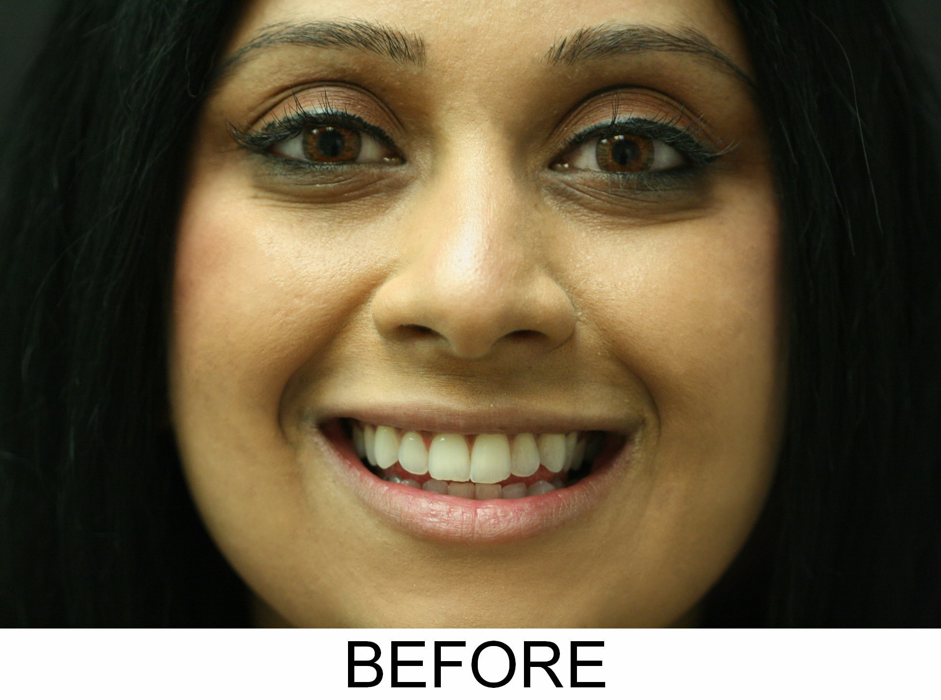 Crowns and Veneers - Before