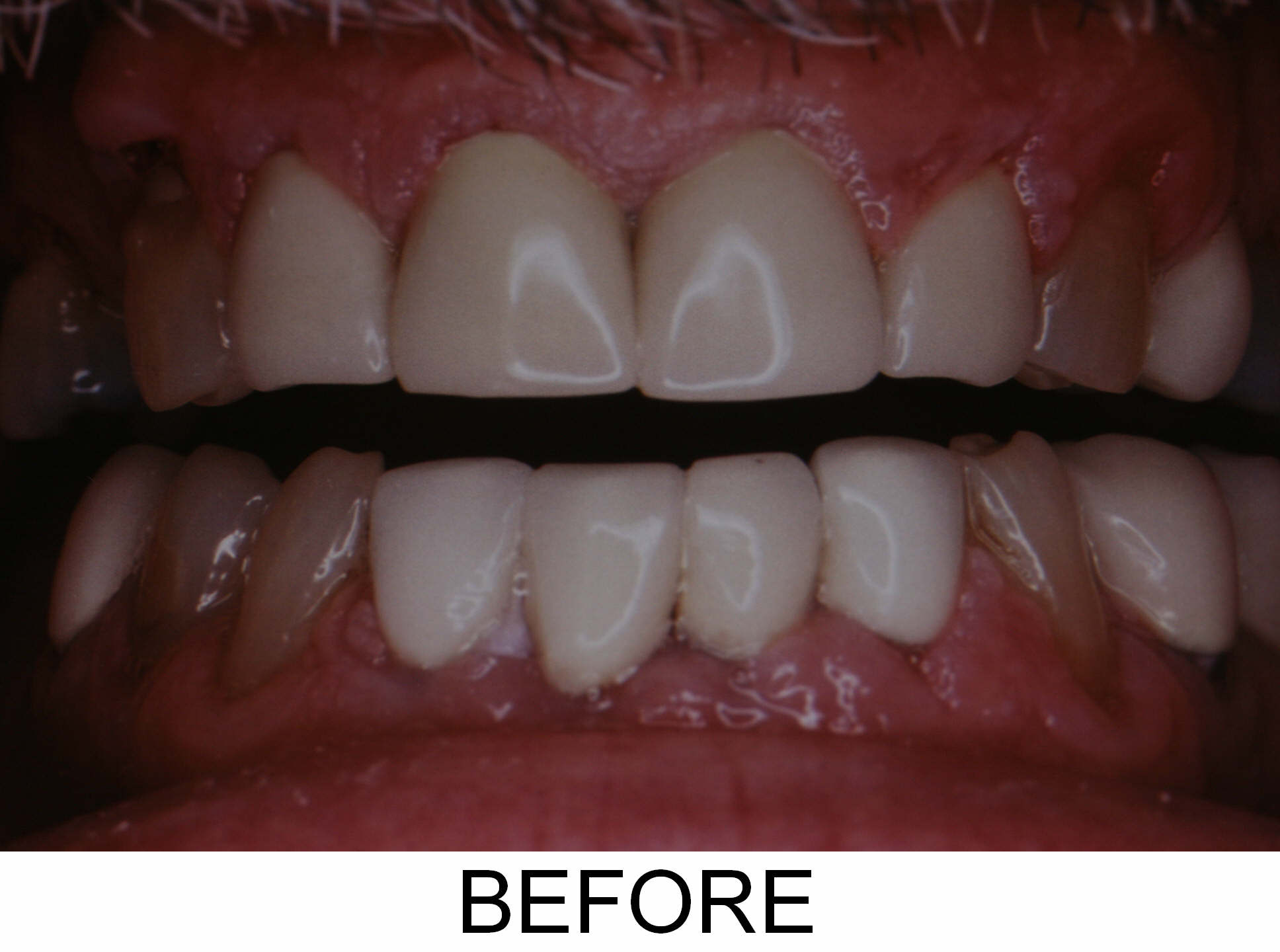 Crowns and Veneers - Before