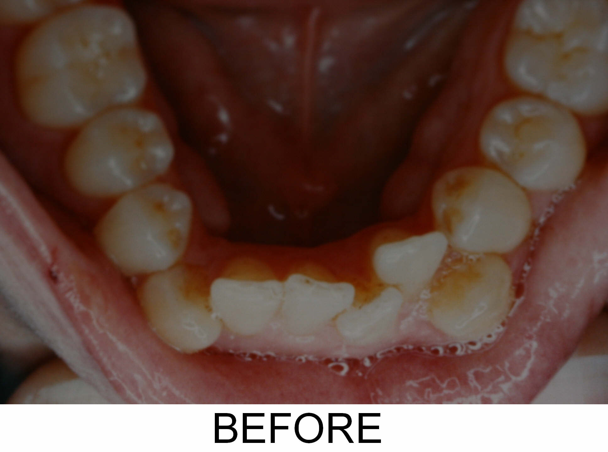 Invisalign - After