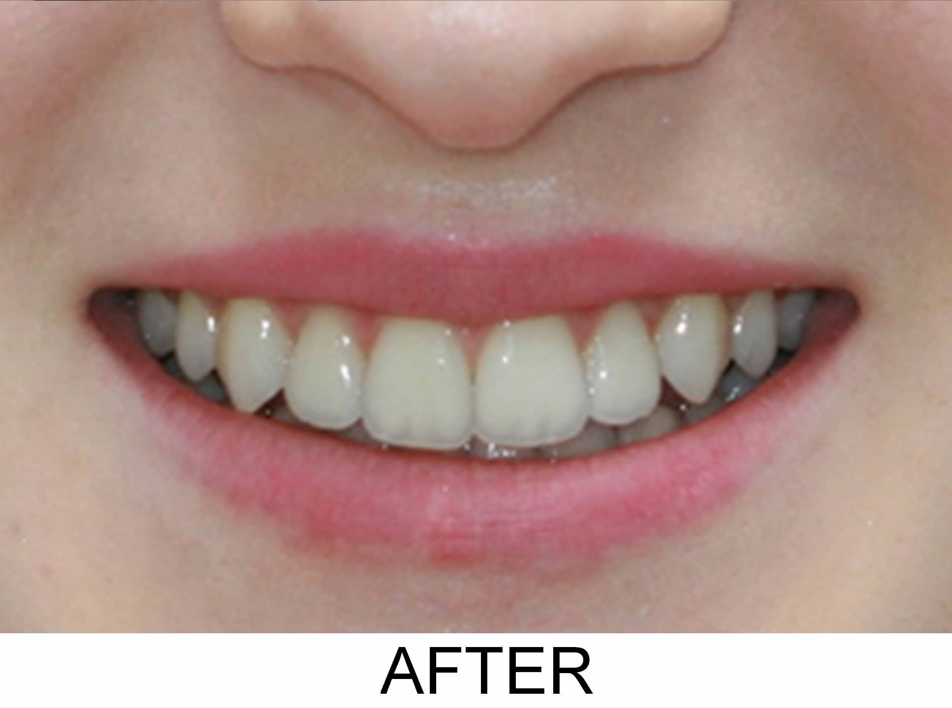 Invisalign and Bleaching - After