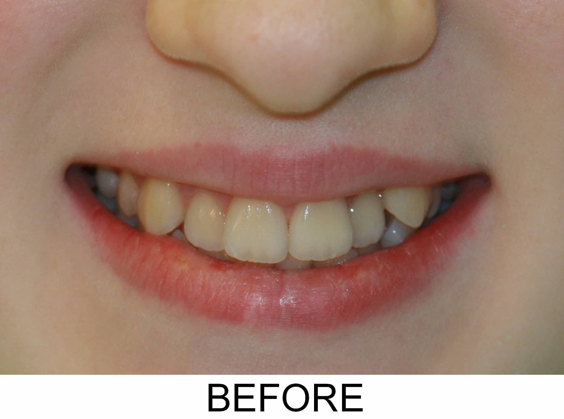 Invisalign and Bleaching - Before