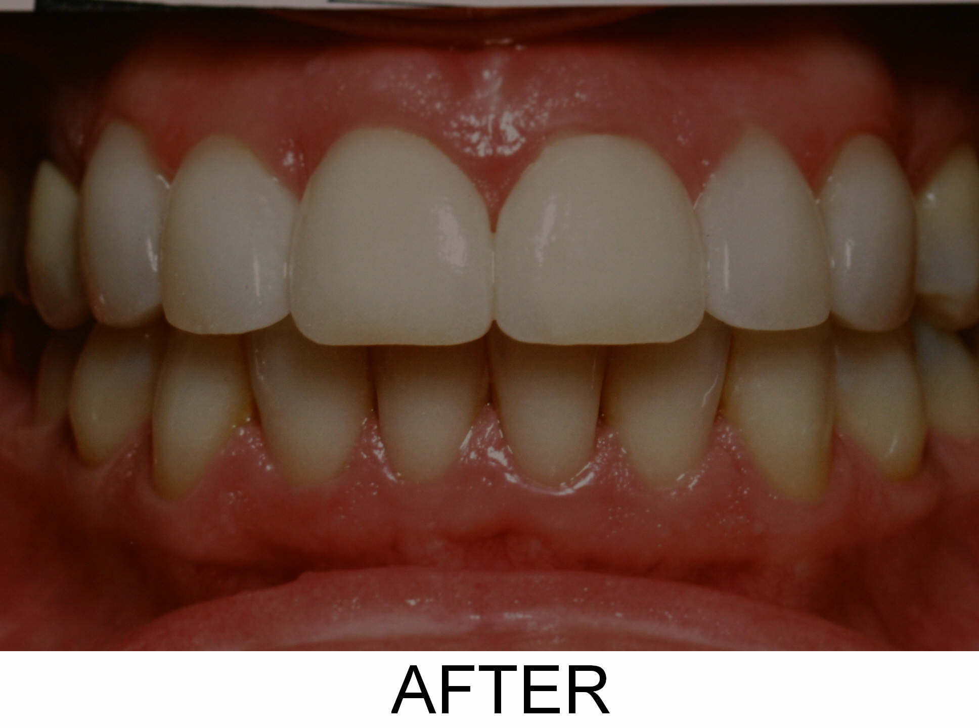Invisalign and Veneers - After