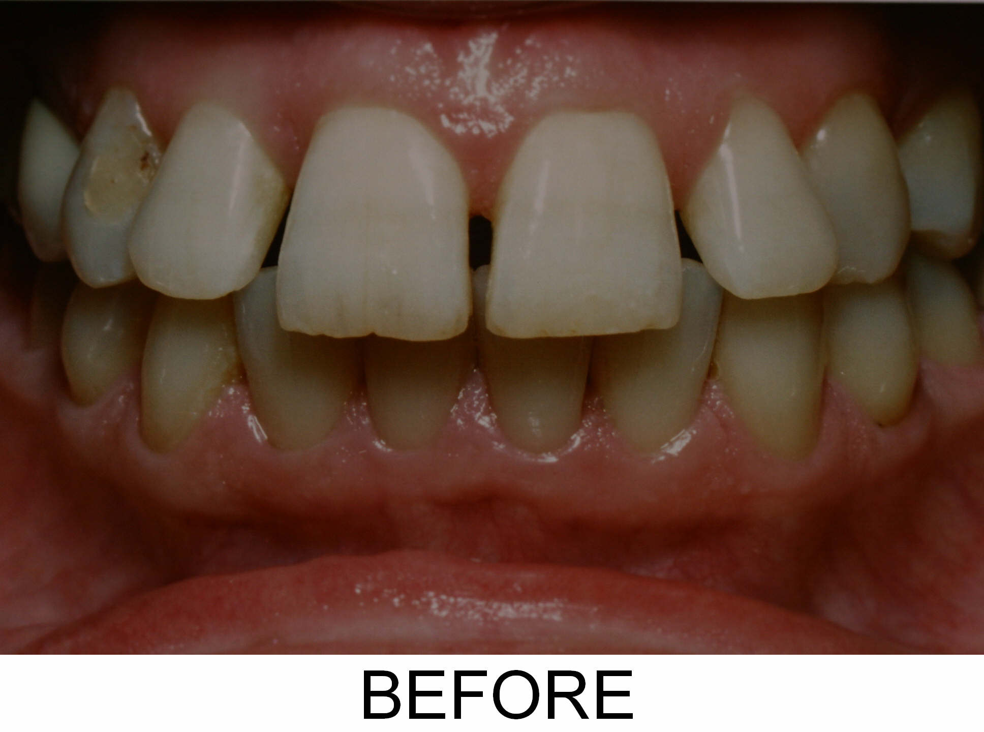 Invisalign and Veneers - Before
