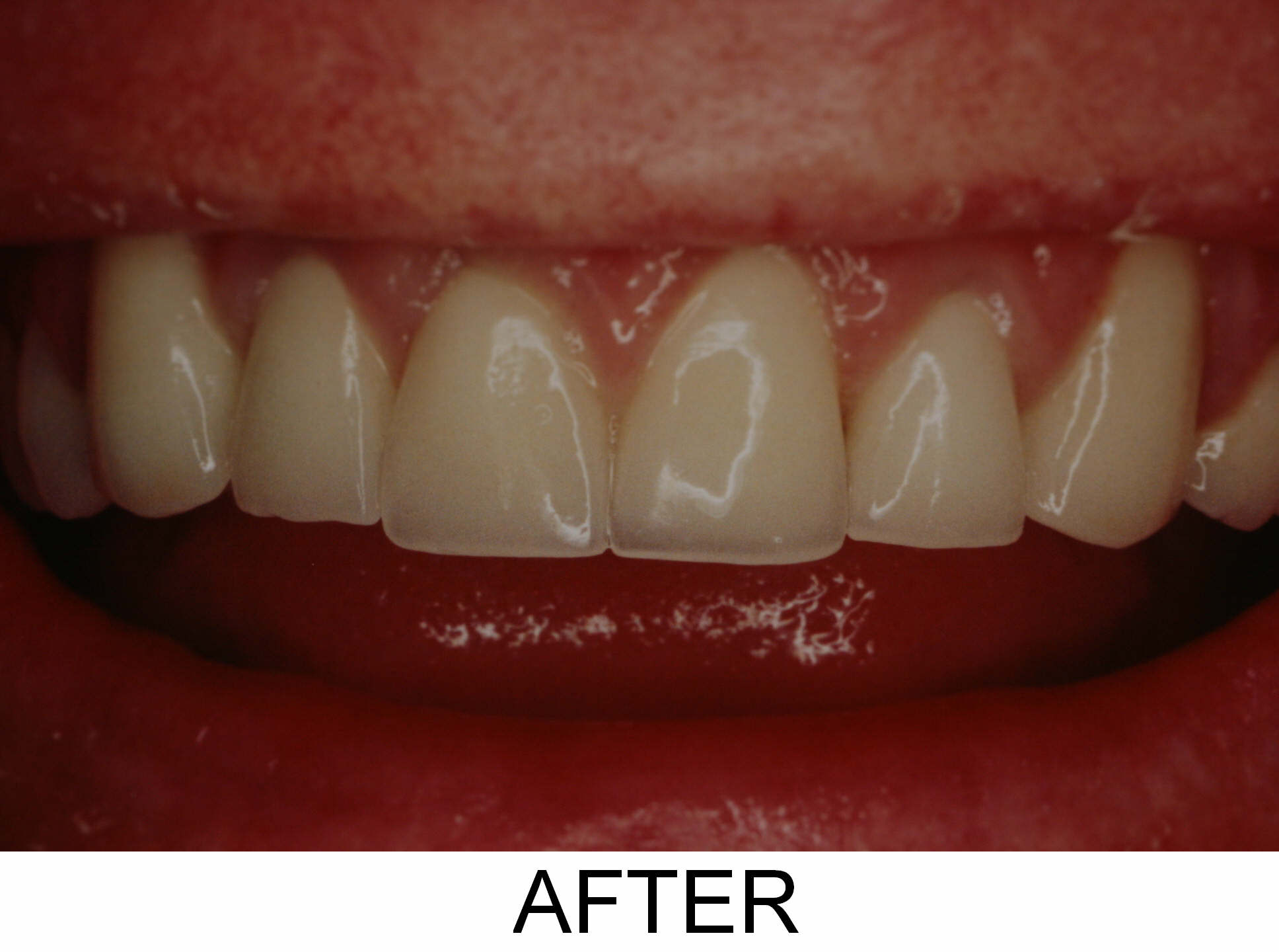Veneers - After
