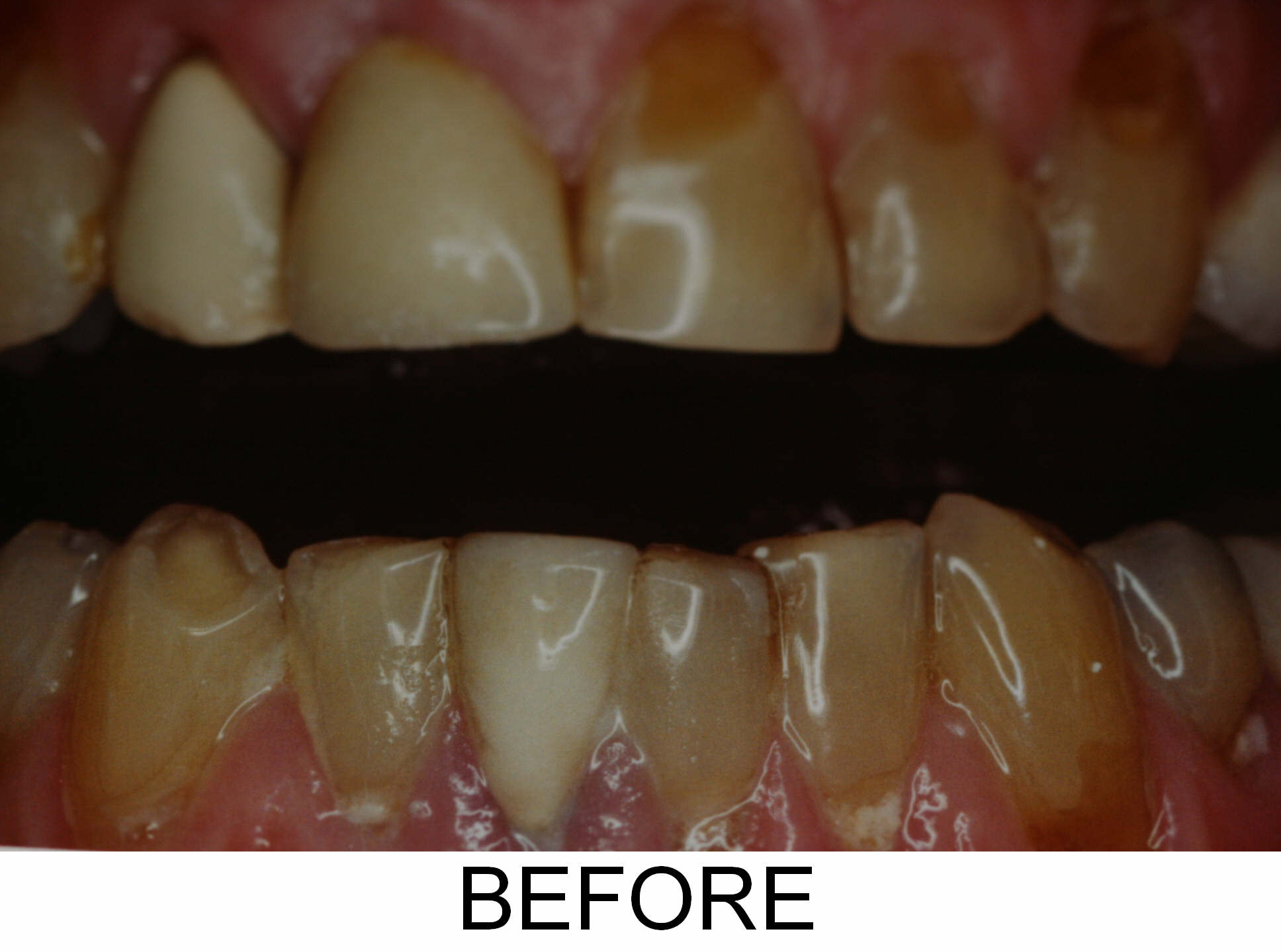 Veneers - Before